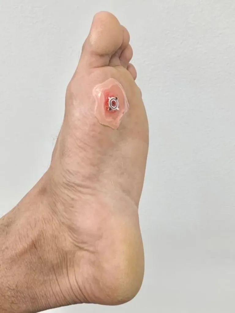 The $1 bandage in action on a human foot