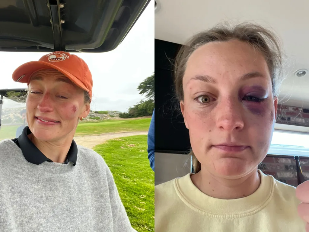 Jessica shows the facial bruising and black eye she suffered after being hit by a rogue golf ball during a round in California.